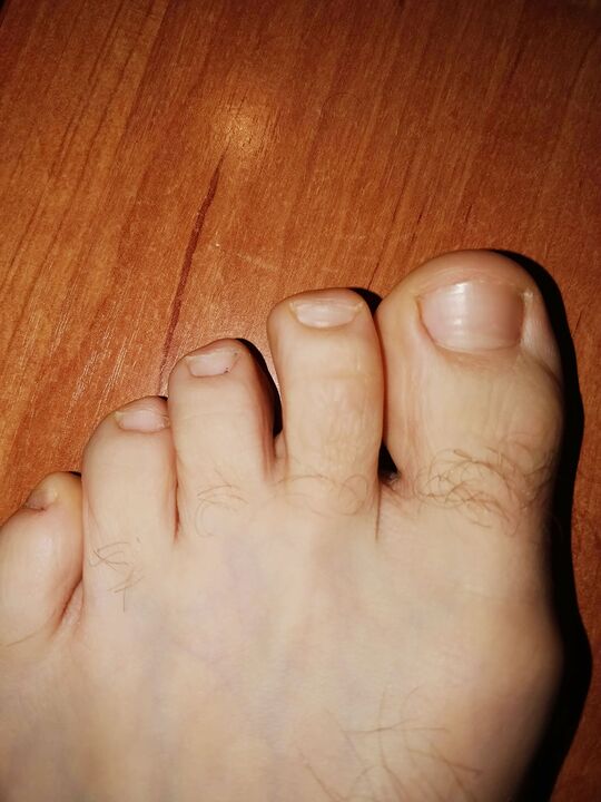 Pies sin hongos después de aplicar la crema Brand Exodermina jand
